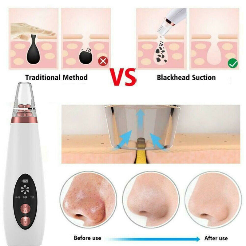 Free shipping-6 in 1 Electric Facial Blackhead Remover